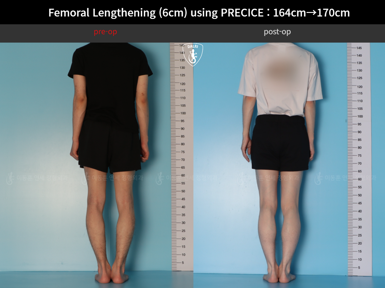 Before and after cll precice, case 33570290, image 2, Dr. Donghoon institute (DALRI)