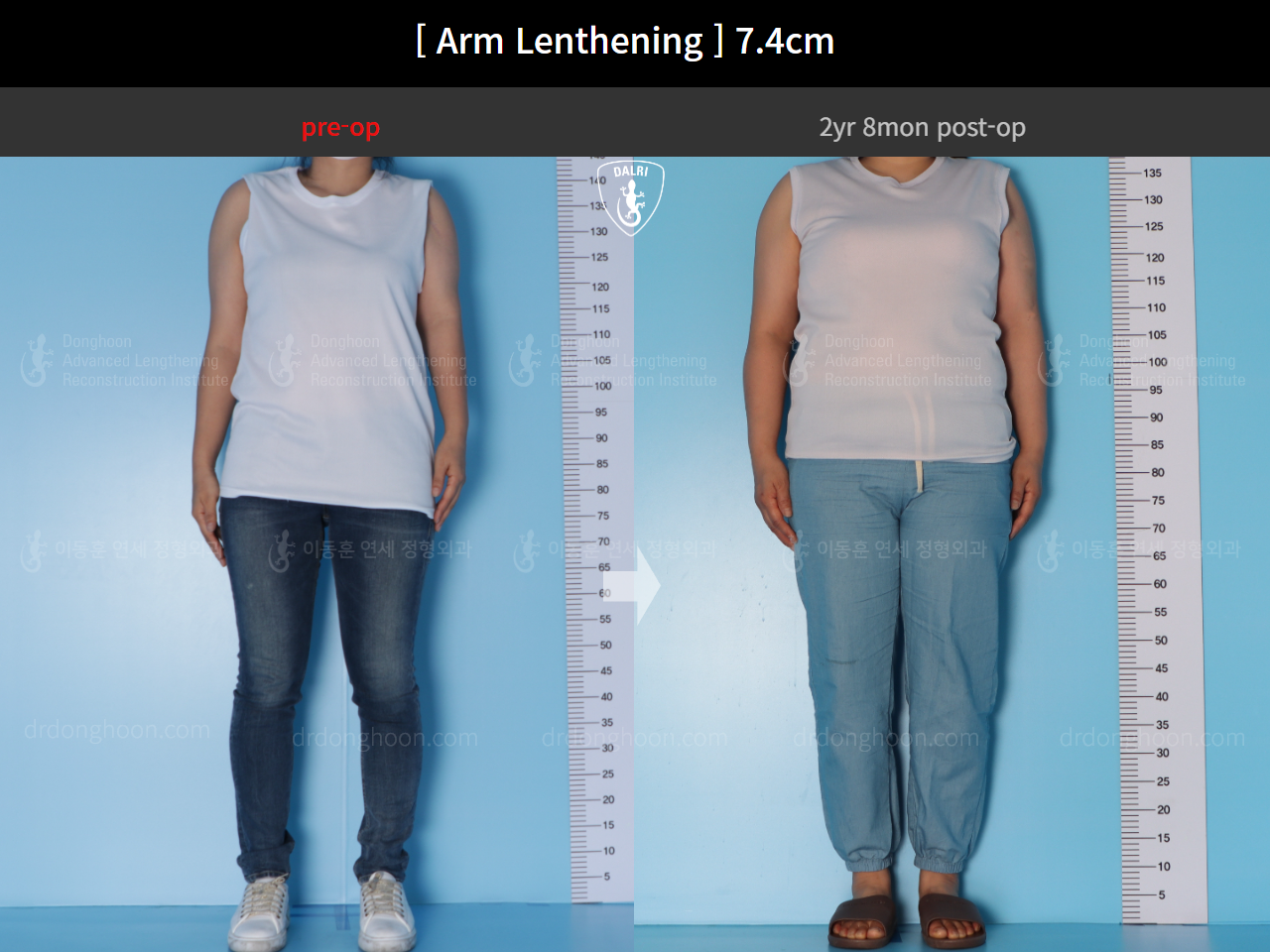 Before and after arm lengthening, case 15460631, image 4, Dr. Donghoon institute (DALRI)