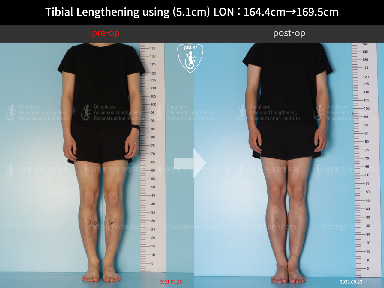 Before and after cll lon, case 12653375, image 1, Dr. Donghoon institute (DALRI)