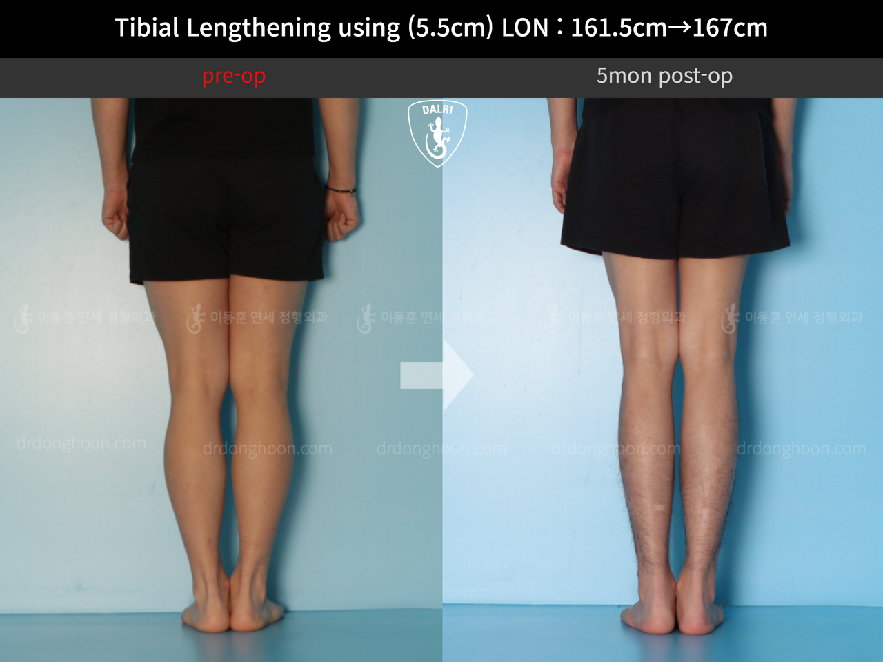 Before and after cll lon, case 12641751, image 6, Dr. Donghoon institute (DALRI)