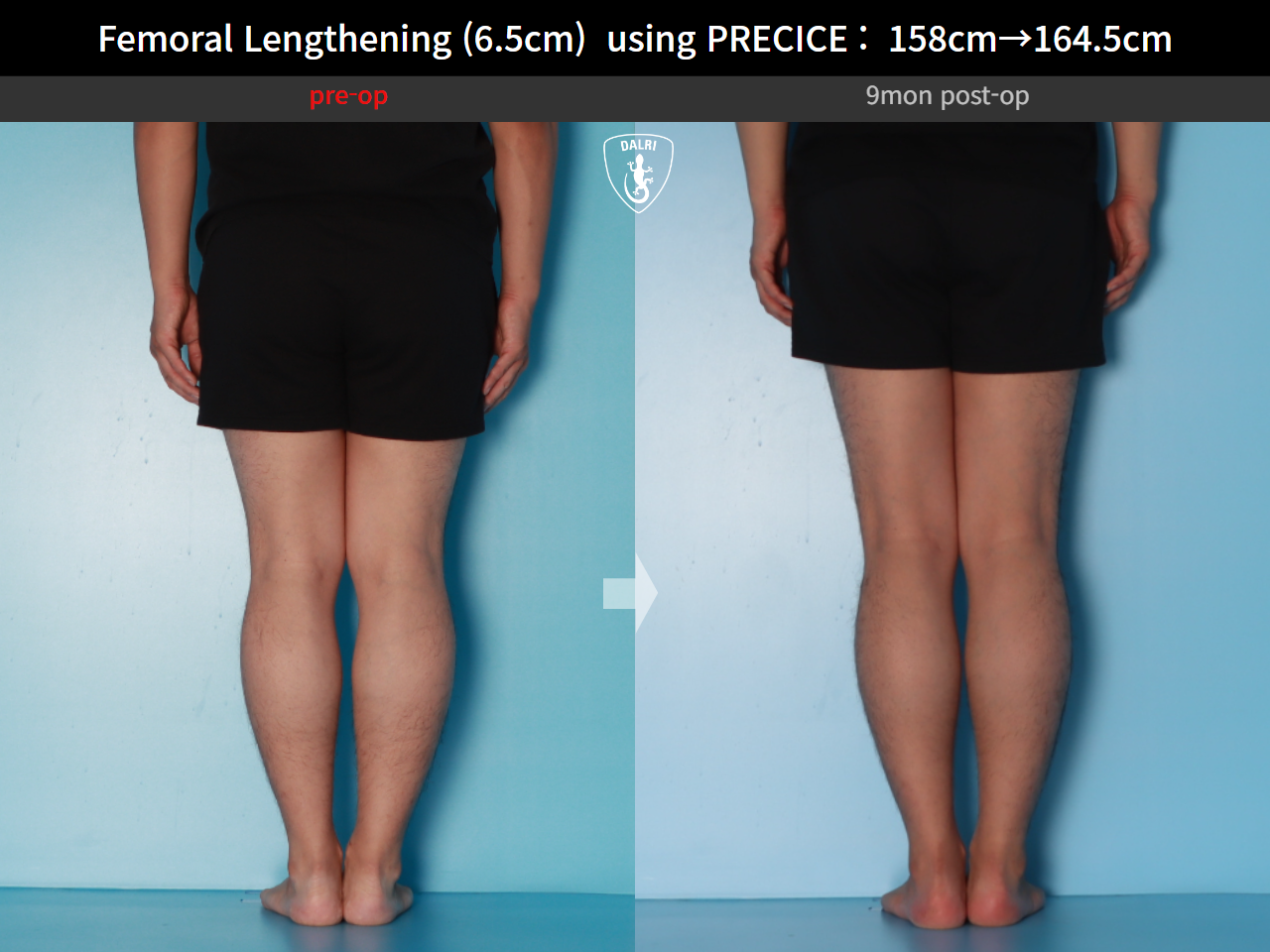 Before and after cll precice, case 28297898, image 8, Dr. Donghoon institute (DALRI)