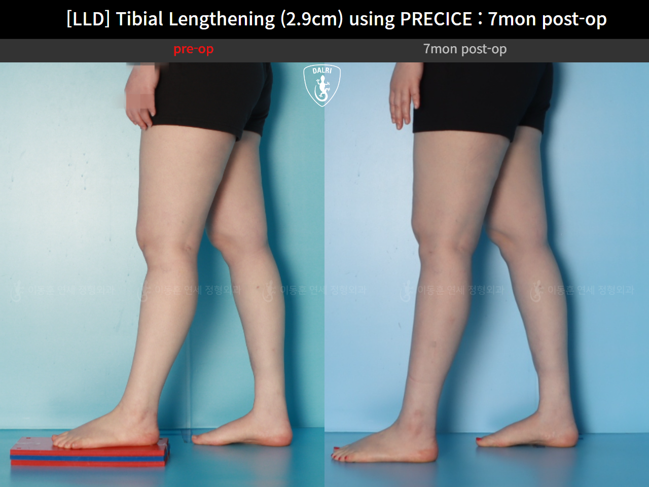 Before and after adult lld, case 62389039, image 7, Dr. Donghoon institute (DALRI)