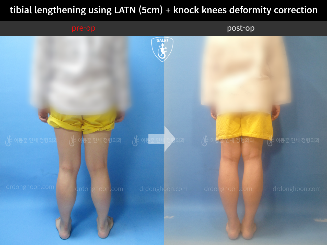 Before and after cll + deformity correction, case 4323180, image 2, Dr. Donghoon institute (DALRI)