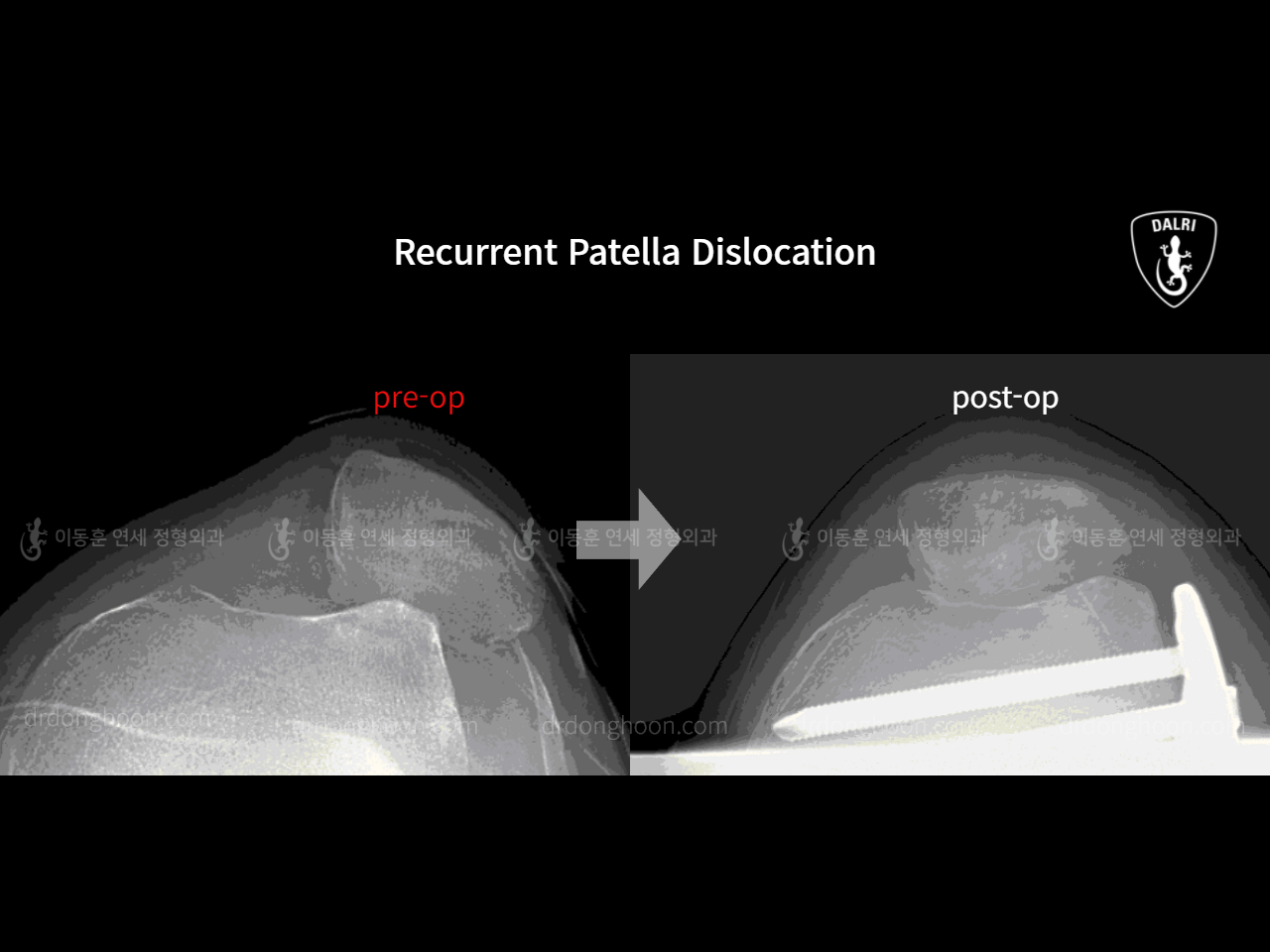 Before and after recurrent patella dislocation, case 10546870, image 7, Dr. Donghoon institute (DALRI)