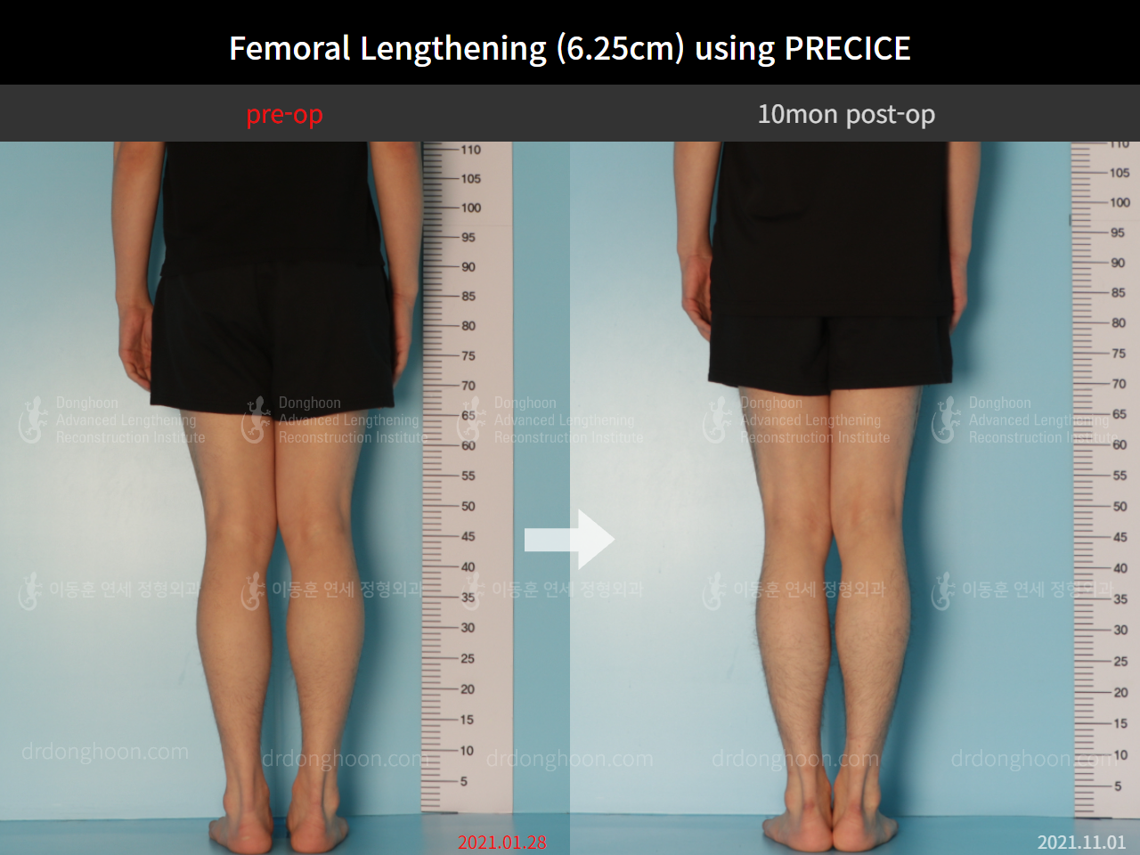 Before and after cll precice, case 8759307, image 6, Dr. Donghoon institute (DALRI)