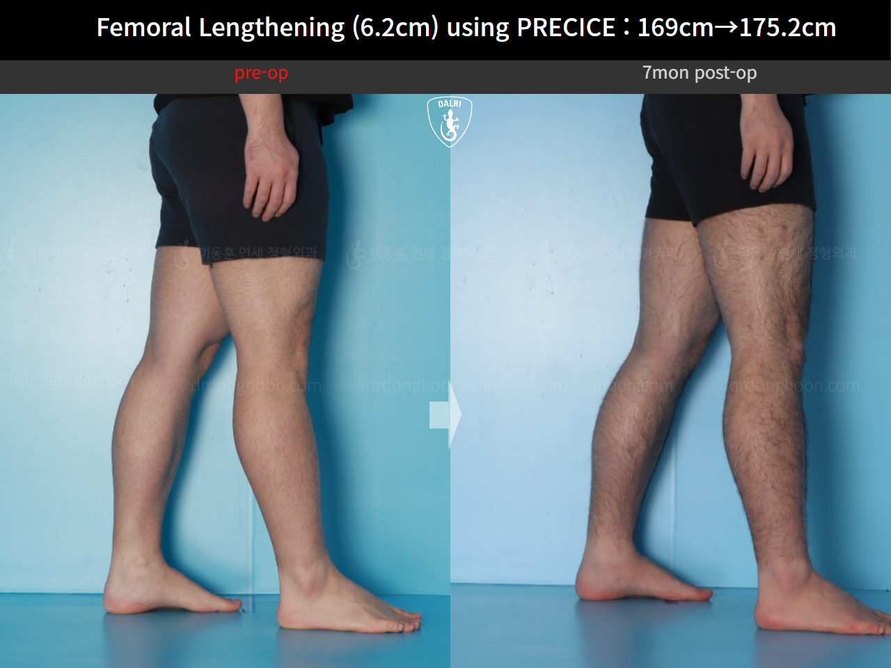 Before and after cll precice, case 20671201, image 10, Dr. Donghoon institute (DALRI)