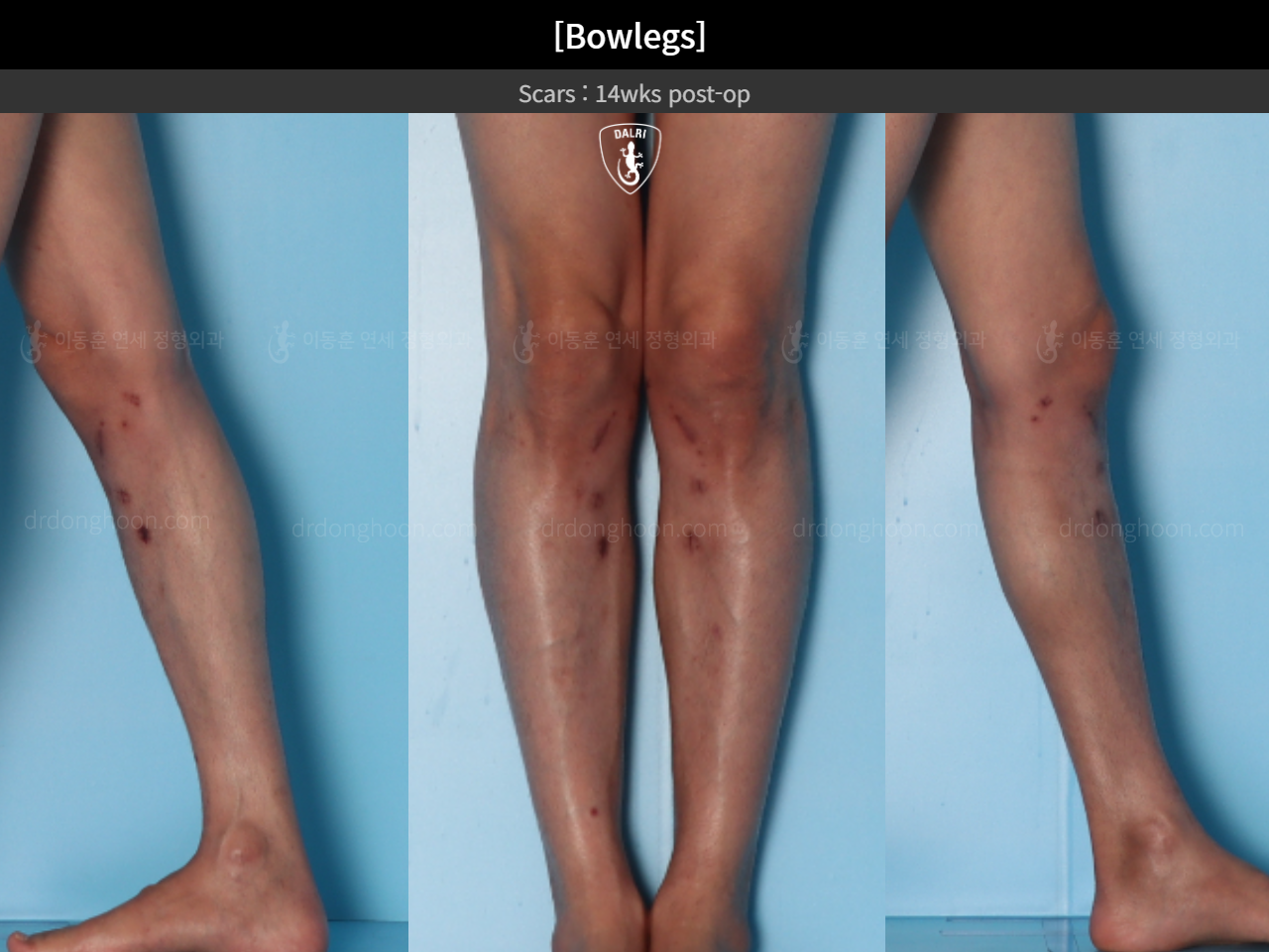 Before and after adult bowlegs, case 15512423, image 10, Dr. Donghoon institute (DALRI)