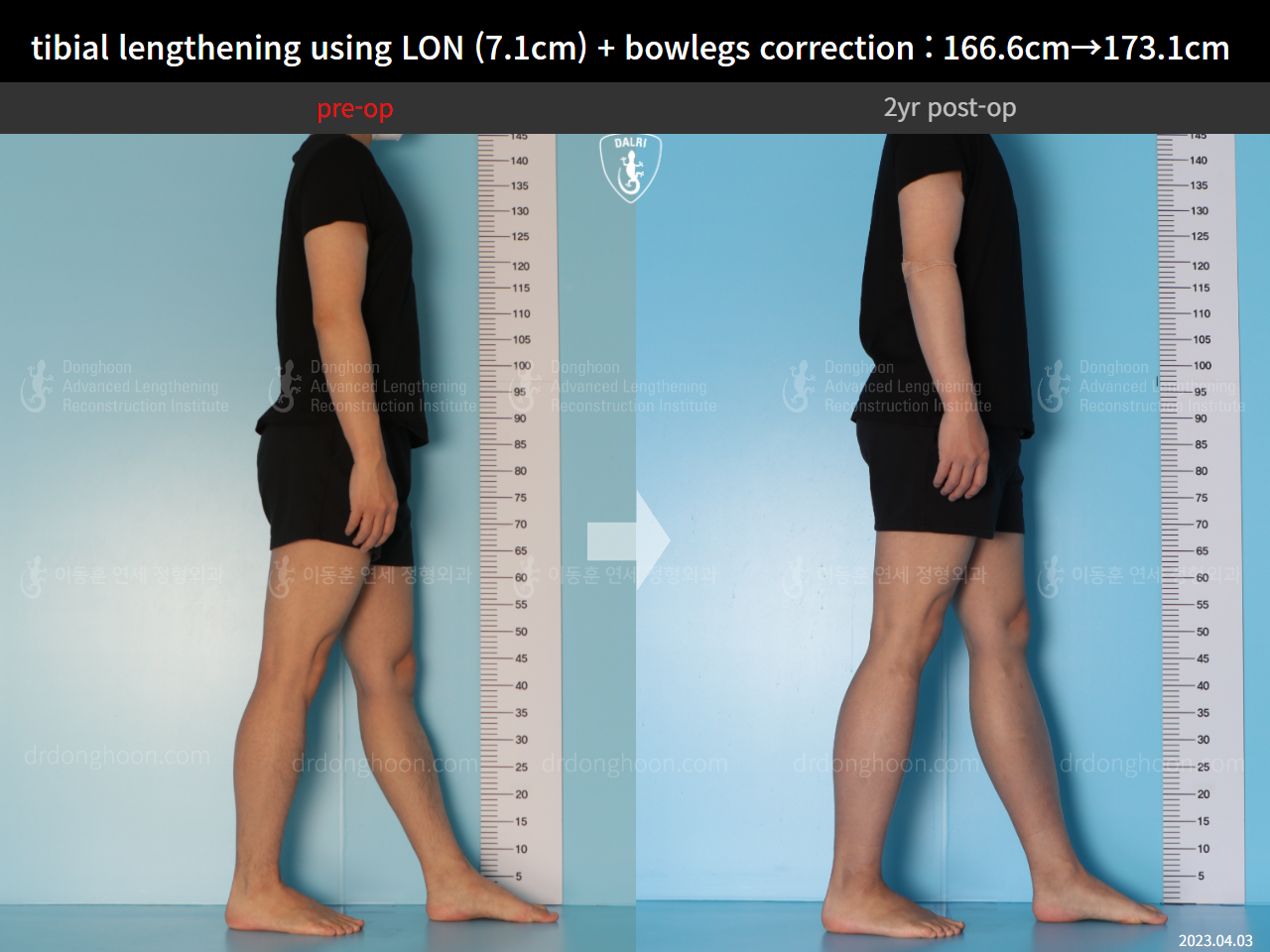 Before and after cll lon, case 14678740, image 3, Dr. Donghoon institute (DALRI)