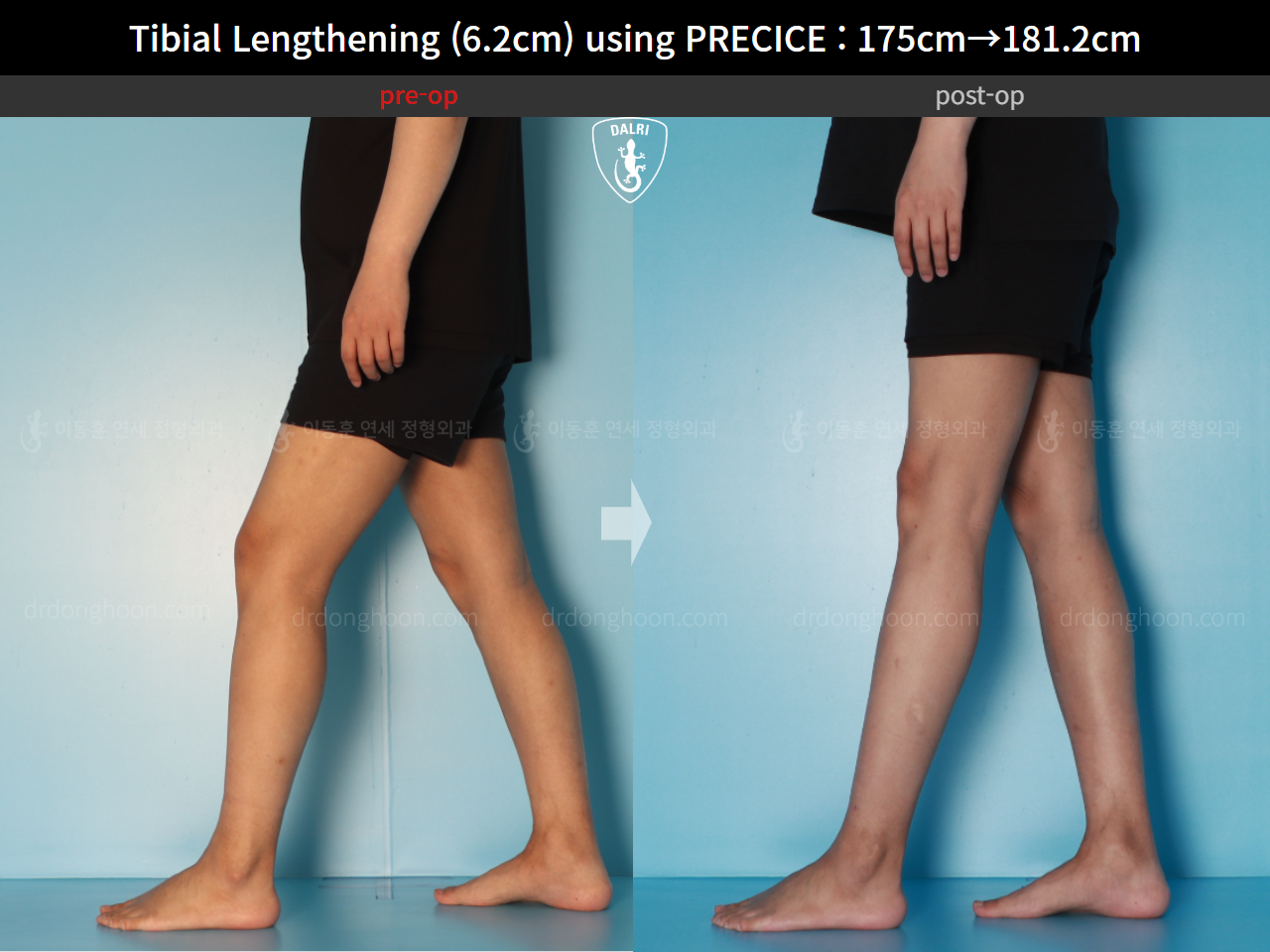 Before and after cll precice, case 16277428, image 11, Dr. Donghoon institute (DALRI)
