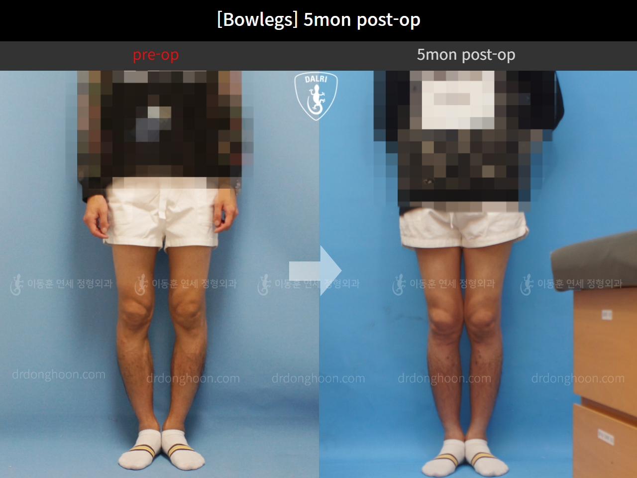 Before and after adult bowlegs, case 4311030, image 2, Dr. Donghoon institute (DALRI)