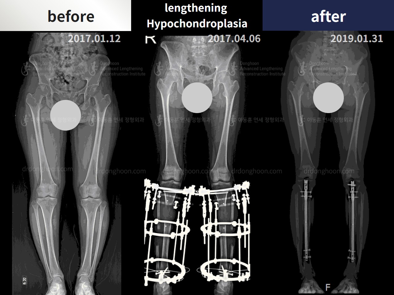 Before and after adult bowlegs, case 4310962, image 3, Dr. Donghoon institute (DALRI)