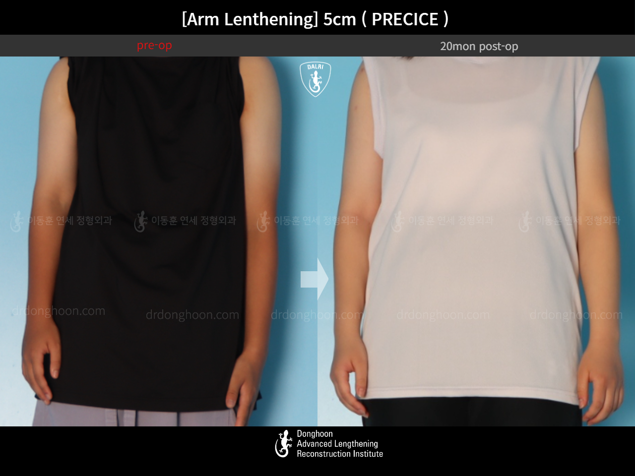 Before and after arm lengthening, case 18471704, image 4, Dr. Donghoon institute (DALRI)
