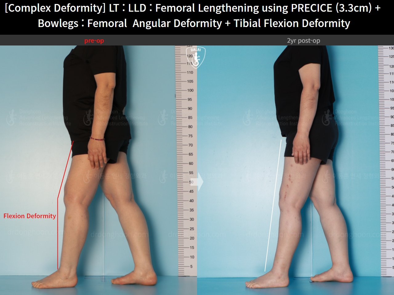 Before and after osteotomy for knee osteoarthritis, case 16786712, image 10, Dr. Donghoon institute (DALRI)