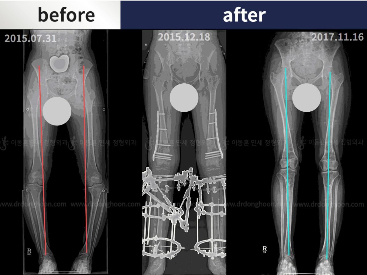 Before and after paediatric & adolescent bowlegs, case 4320276, image 3, Dr. Donghoon institute (DALRI)