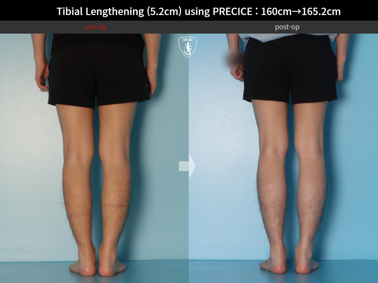 Before and after cll precice, case 27370351, image 6, Dr. Donghoon institute (DALRI)