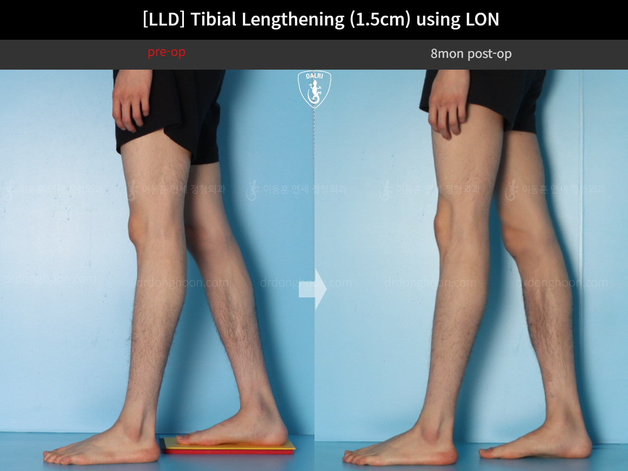 Before and after adult lld, case 18244334, image 8, Dr. Donghoon institute (DALRI)