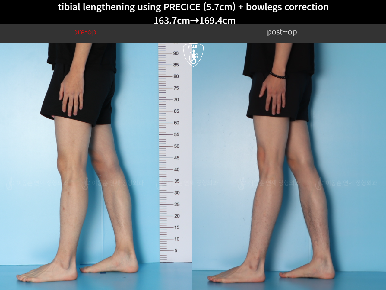 Before and after cll + deformity correction, case 38471595, image 7, Dr. Donghoon institute (DALRI)