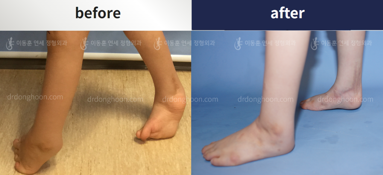 Before and after foot & ankle deformity, case 4367971, image 2, Dr. Donghoon institute (DALRI)