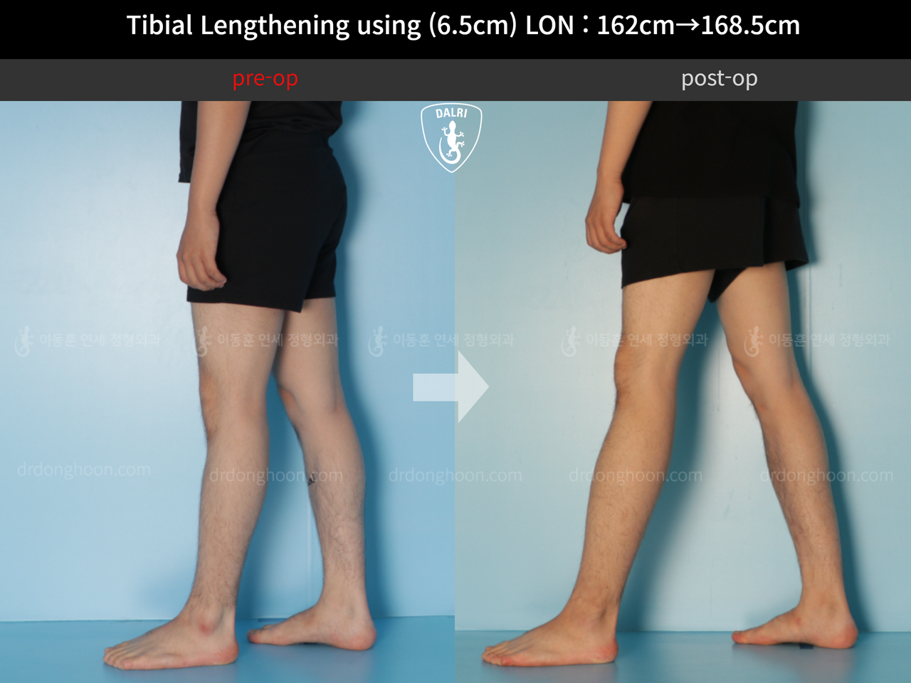 Before and after cll lon, case 11944171, image 8, Dr. Donghoon institute (DALRI)