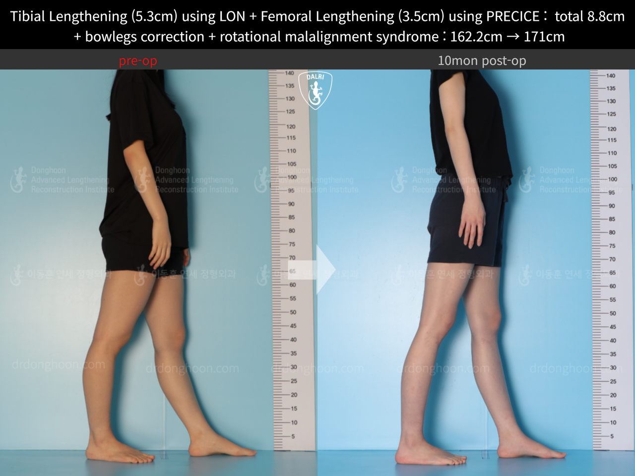 Before and after cll + deformity correction, case 13127167, image 7, Dr. Donghoon institute (DALRI)