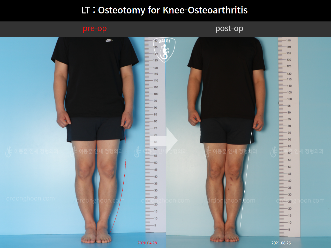 Before and after osteotomy for knee osteoarthritis, case 11065448, image 1, Dr. Donghoon institute (DALRI)