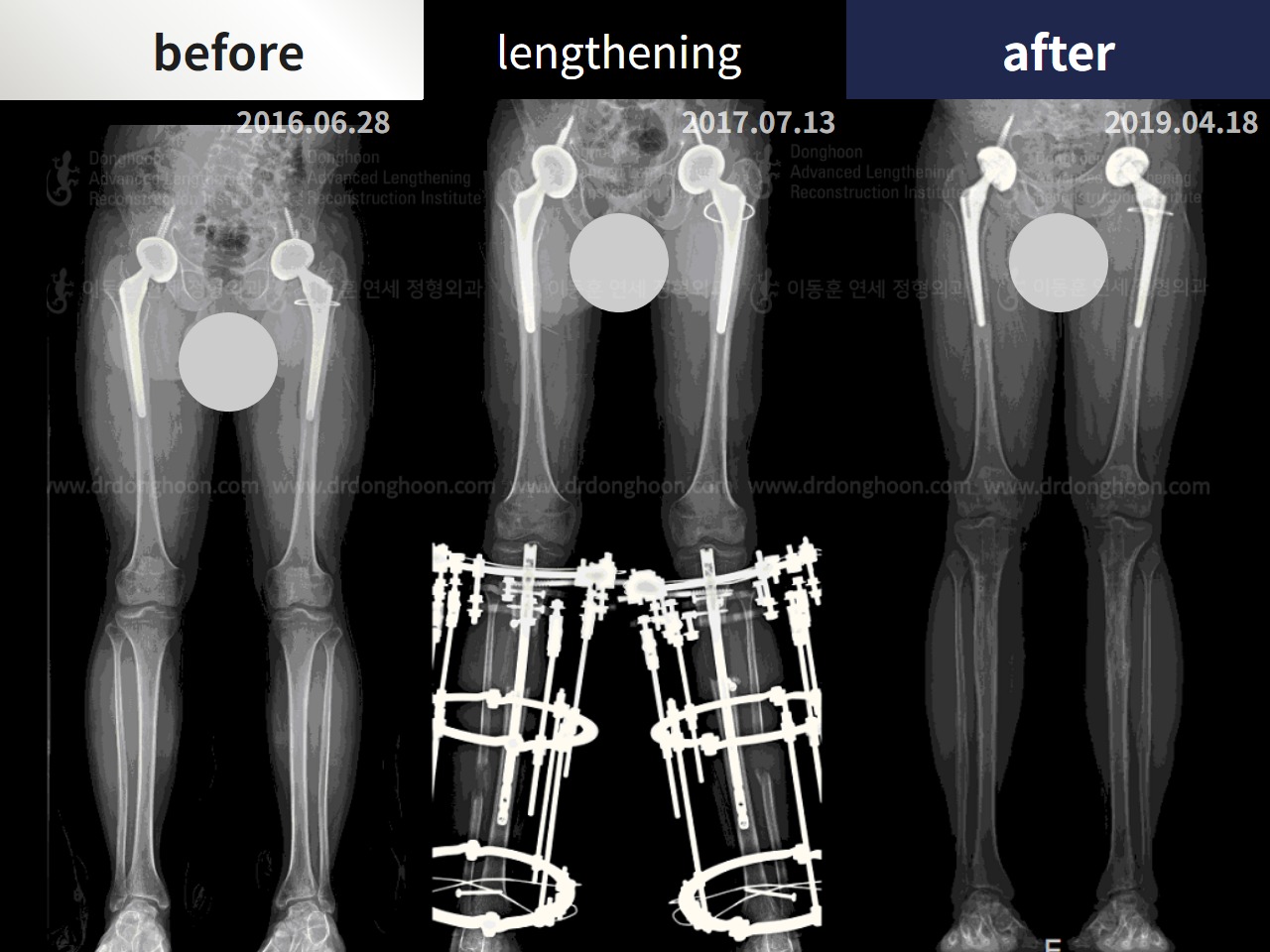 Before and after congenital condition, case 4300006, image 3, Dr. Donghoon institute (DALRI)