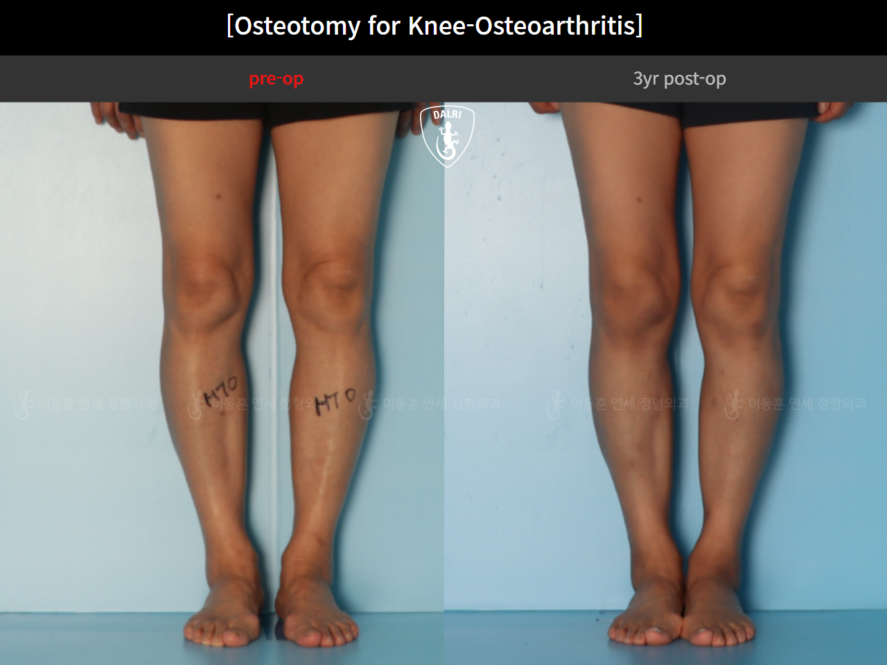 Before and after osteotomy for knee osteoarthritis, case 85842641, image 7, Dr. Donghoon institute (DALRI)