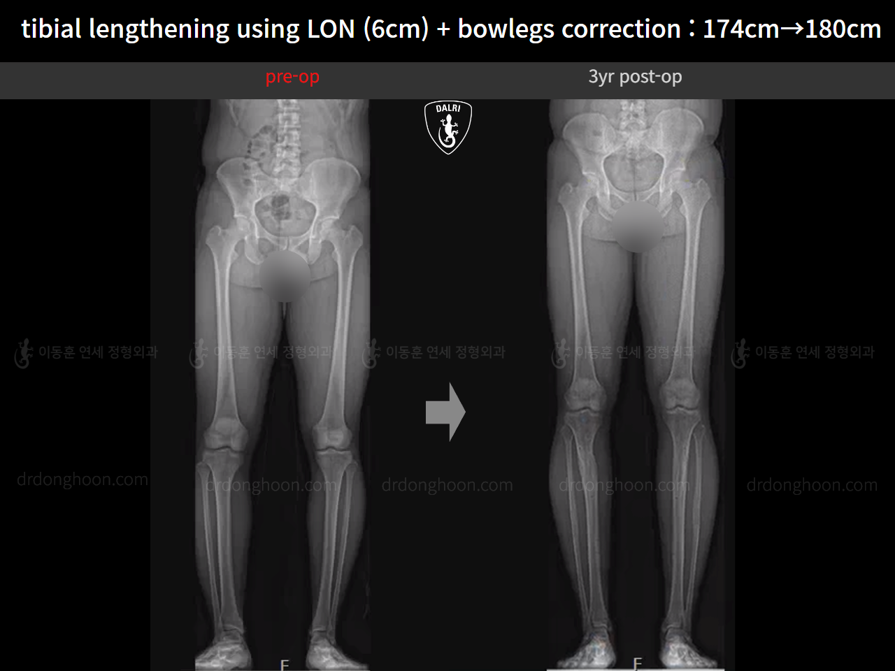 Before and after cll + deformity correction, case 18228446, image 2, Dr. Donghoon institute (DALRI)