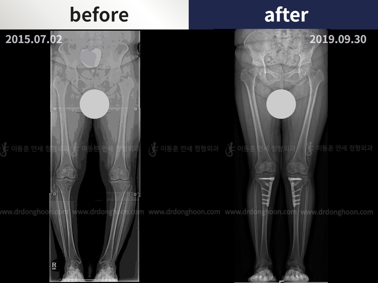Before and after osteotomy for knee osteoarthritis, case 4306408, image 3, Dr. Donghoon institute (DALRI)