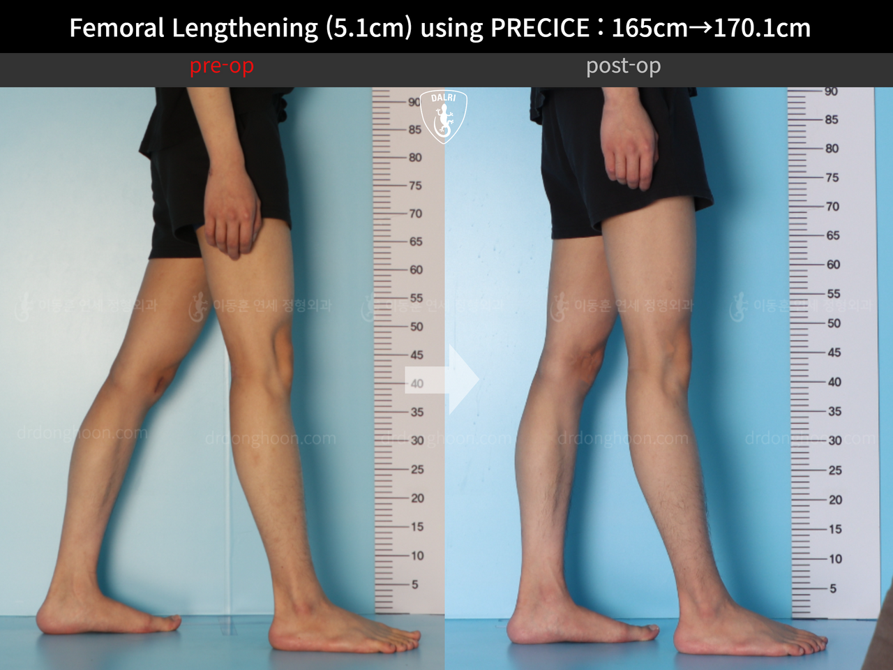 Before and after cll precice, case 13184743, image 7, Dr. Donghoon institute (DALRI)