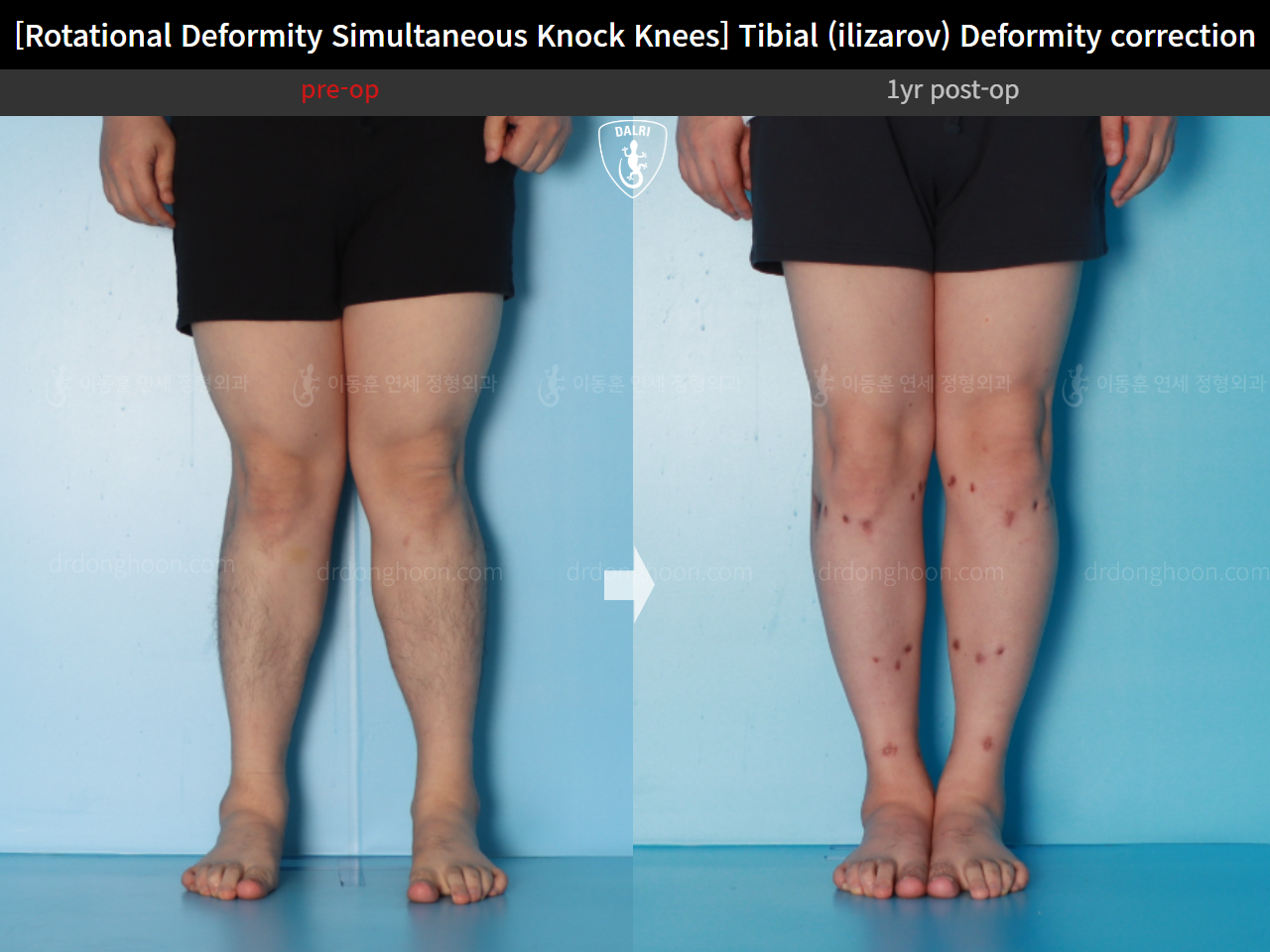 Before and after adult knock knees, case 15977455, image 6, Dr. Donghoon institute (DALRI)