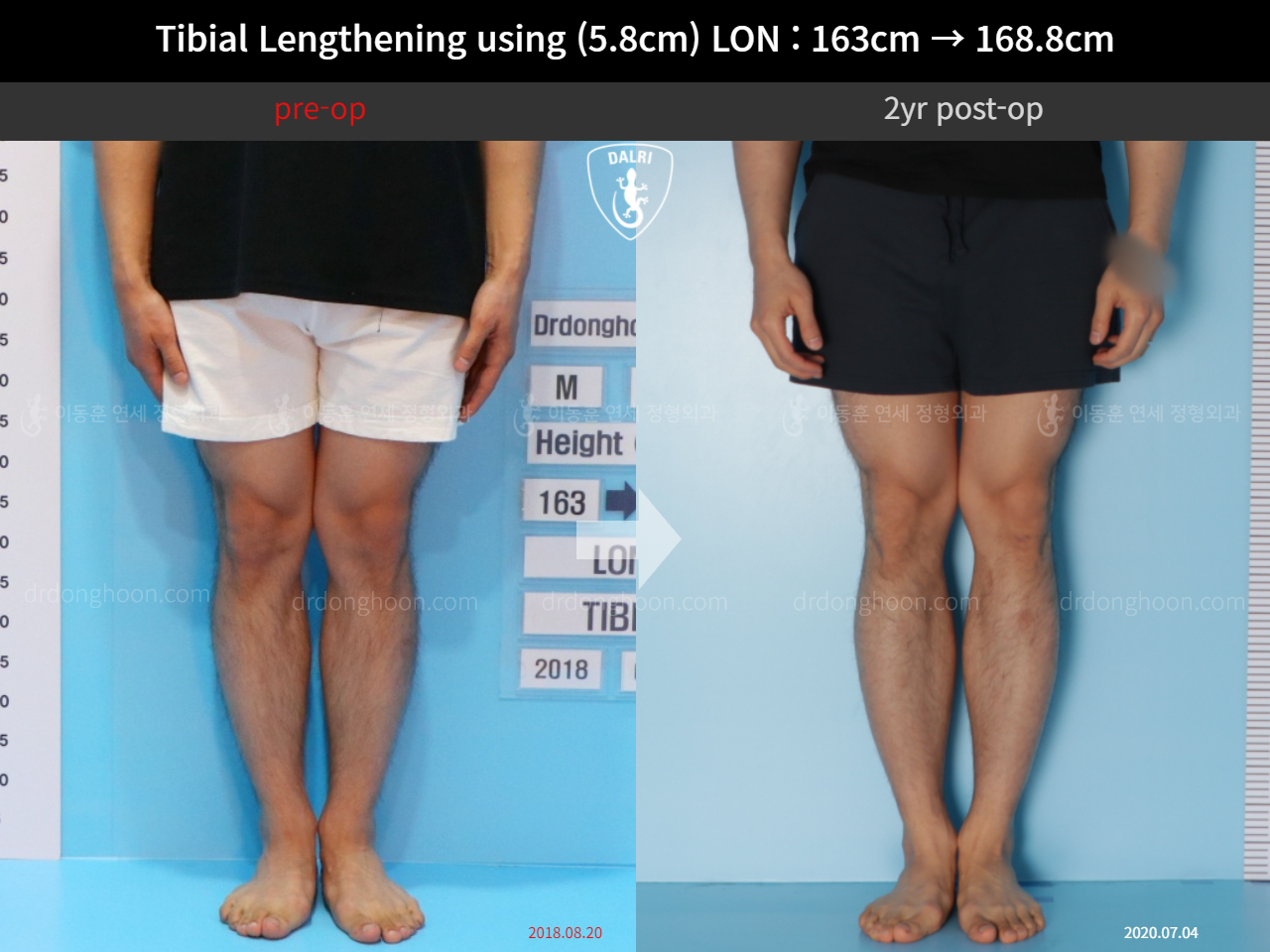 Before and after cll lon, case 11468172, image 5, Dr. Donghoon institute (DALRI)