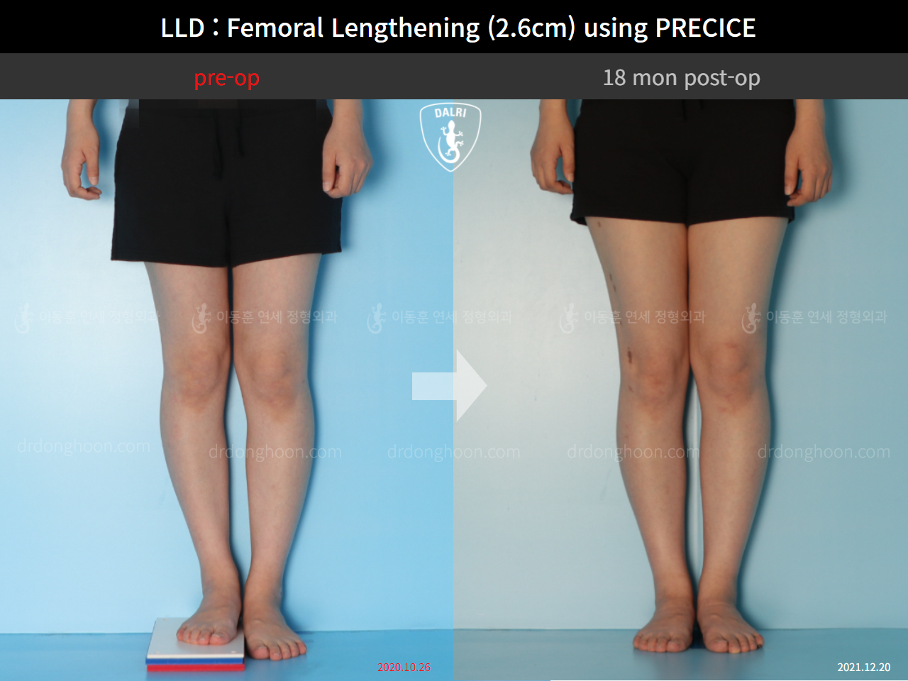Before and after adult lld, case 9332755, image 4, Dr. Donghoon institute (DALRI)