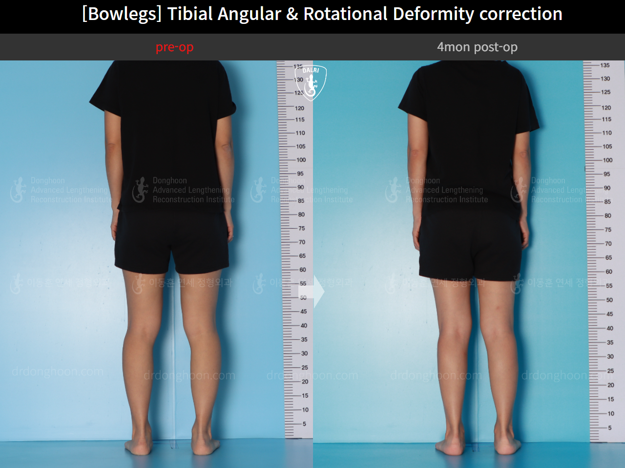 Before and after adult bowlegs, case 16530390, image 5, Dr. Donghoon institute (DALRI)
