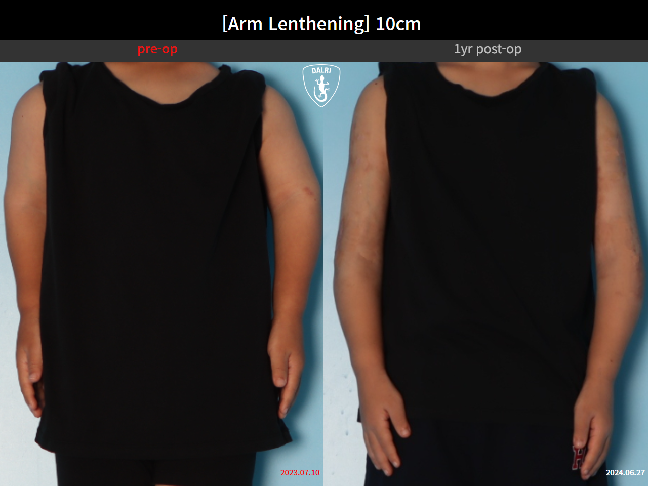 Before and after arm lengthening, case 31284248, image 2, Dr. Donghoon institute (DALRI)