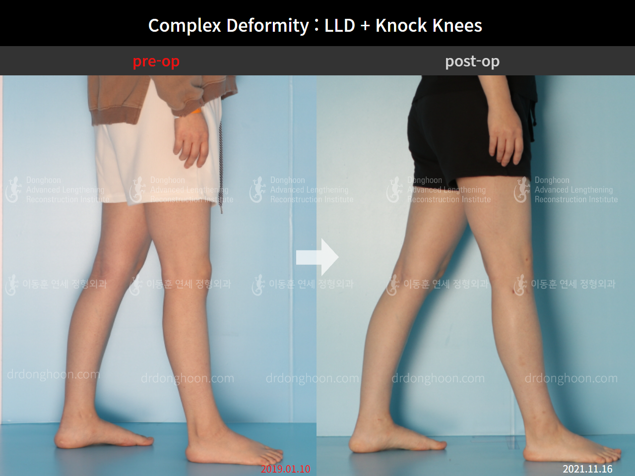 Before and after adult lld, case 9041582, image 3, Dr. Donghoon institute (DALRI)