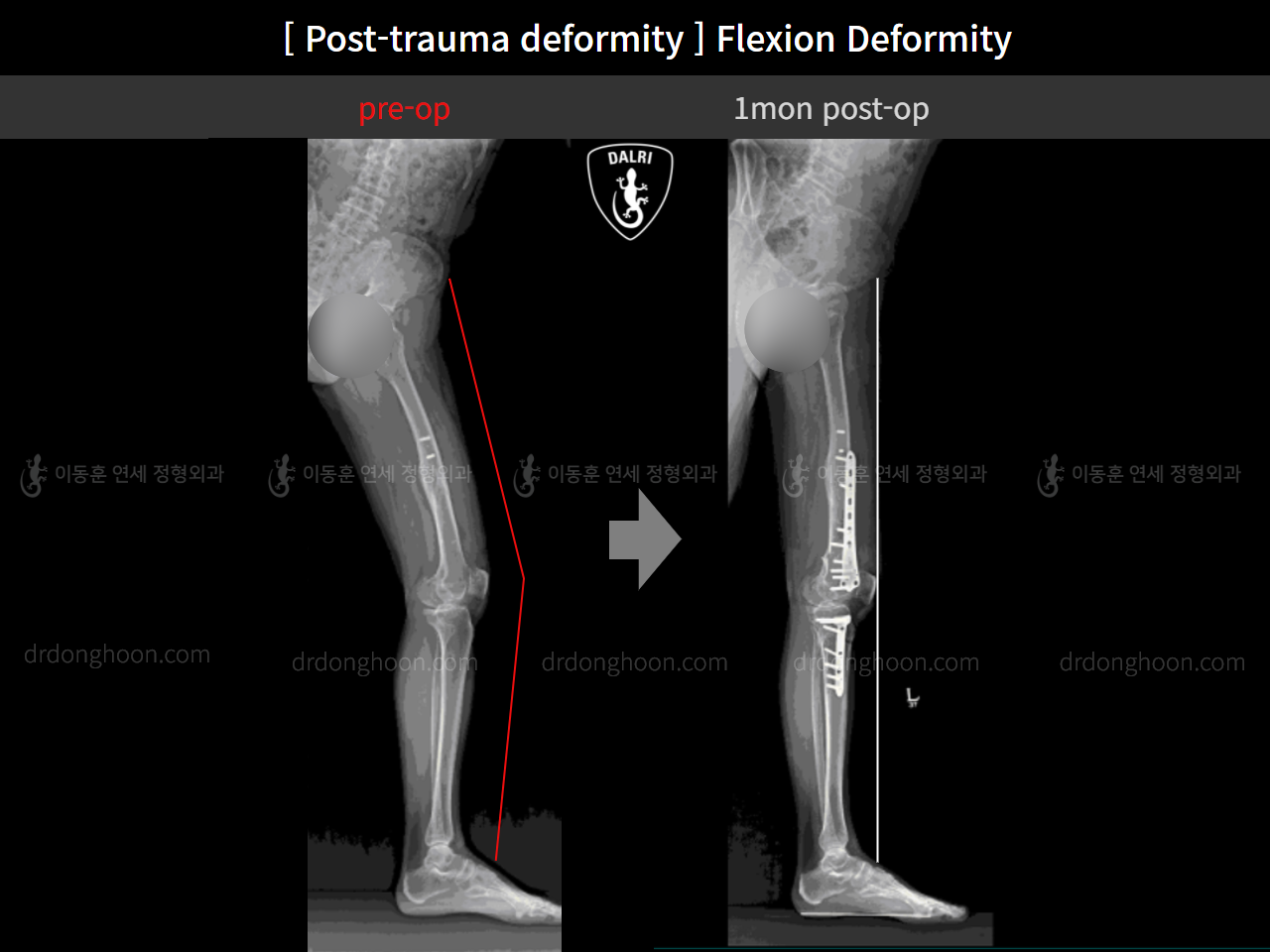 Before and after flexion deformity, case 11231117, image 2, Dr. Donghoon institute (DALRI)