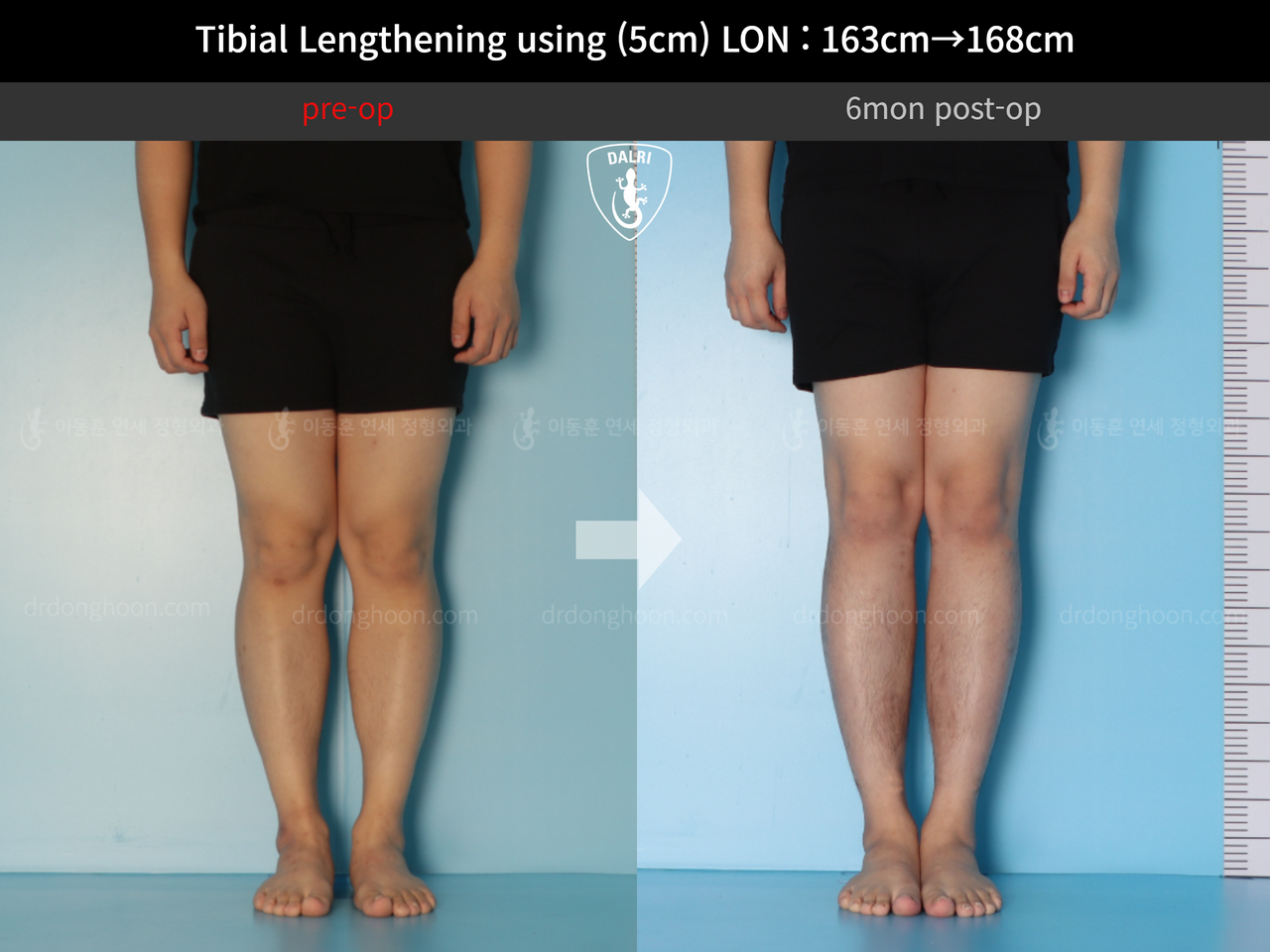 Before and after cll lon, case 12638628, image 4, Dr. Donghoon institute (DALRI)