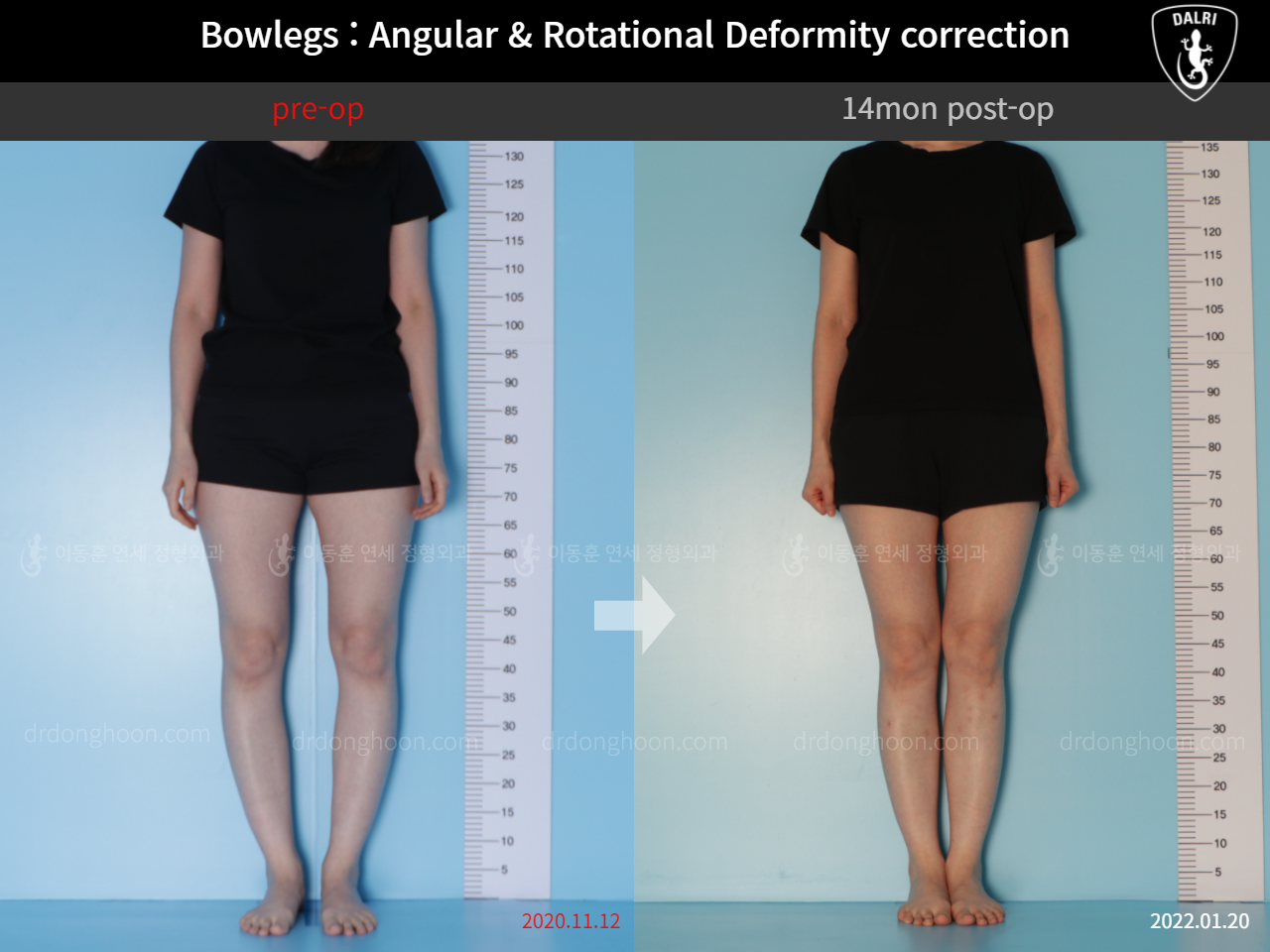 Before and after adult bowlegs, case 9557826, image 3, Dr. Donghoon institute (DALRI)