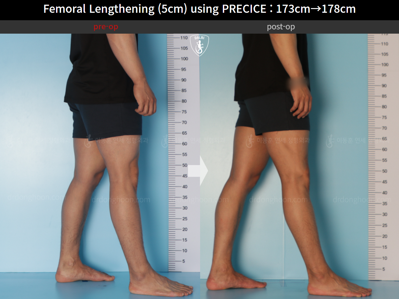 Before and after cll precice, case 21702609, image 9, Dr. Donghoon institute (DALRI)