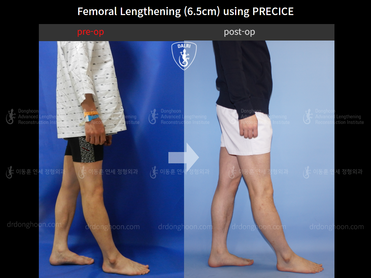 Before and after cll precice, case 4323401, image 3, Dr. Donghoon institute (DALRI)