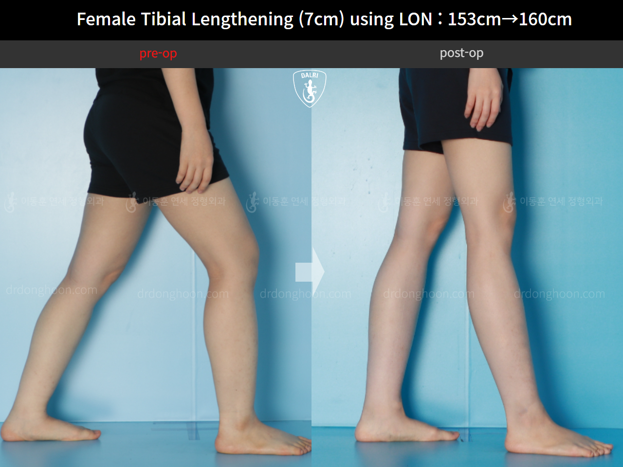 Before and after cll lon, case 16044134, image 8, Dr. Donghoon institute (DALRI)