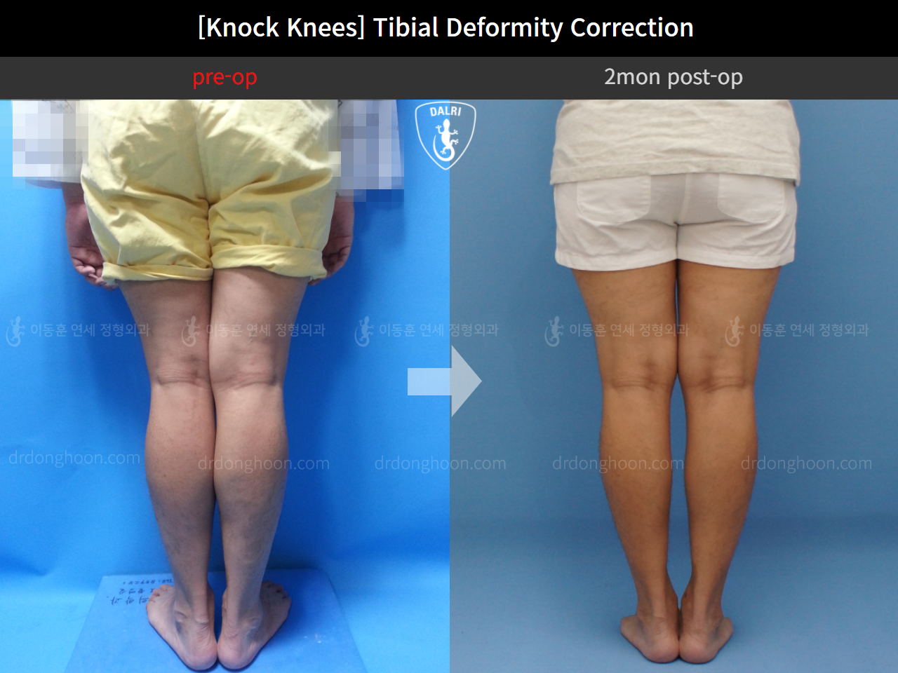 Before and after adult knock knees, case 4310814, image 3, Dr. Donghoon institute (DALRI)
