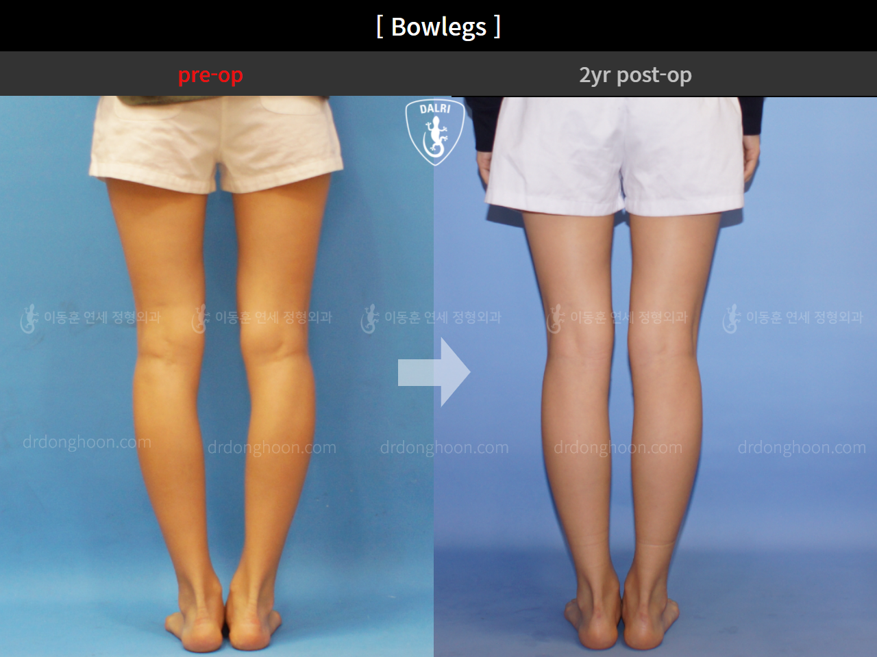 Before and after adult bowlegs, case 4311371, image 6, Dr. Donghoon institute (DALRI)