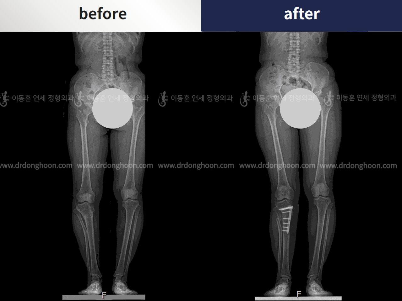 Before and after reoperation after deformity correction, case 4797441, image 5, Dr. Donghoon institute (DALRI)