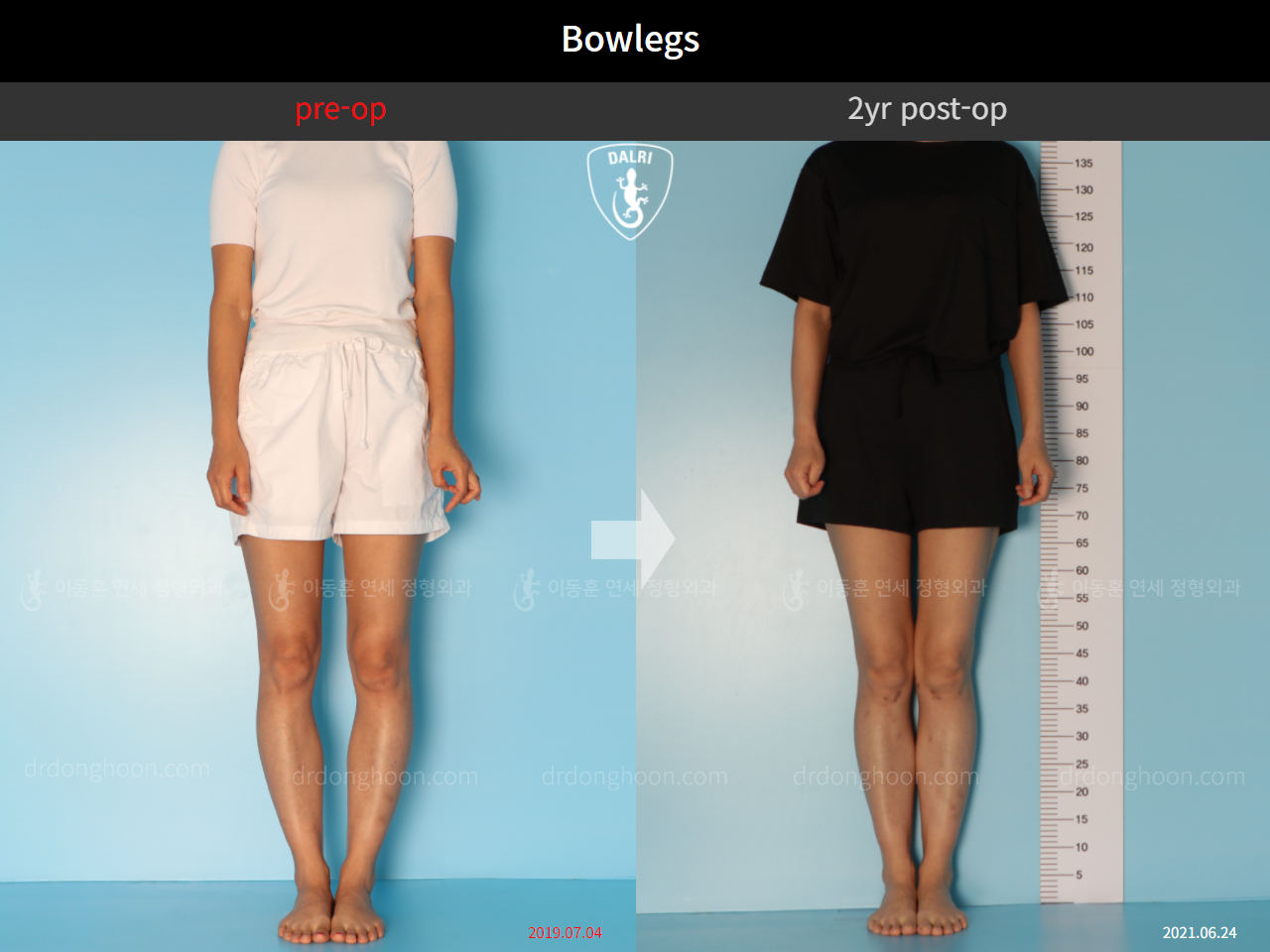 Before and after adult bowlegs, case 10023318, image 3, Dr. Donghoon institute (DALRI)