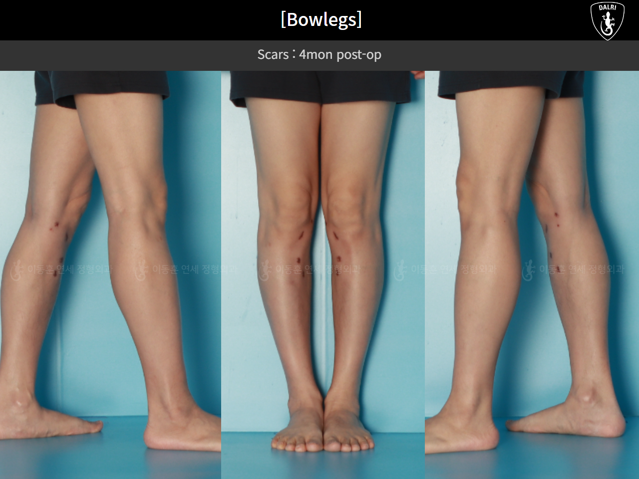 Before and after adult bowlegs, case 125438866, image 11, Dr. Donghoon institute (DALRI)