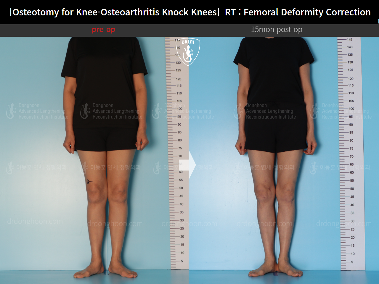 Before and after osteotomy for knee osteoarthritis, case 14462707, image 4, Dr. Donghoon institute (DALRI)