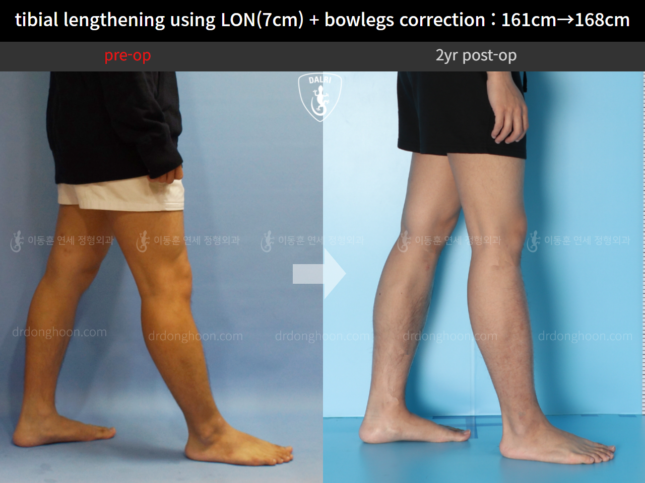 Before and after cll + deformity correction, case 10400088, image 8, Dr. Donghoon institute (DALRI)