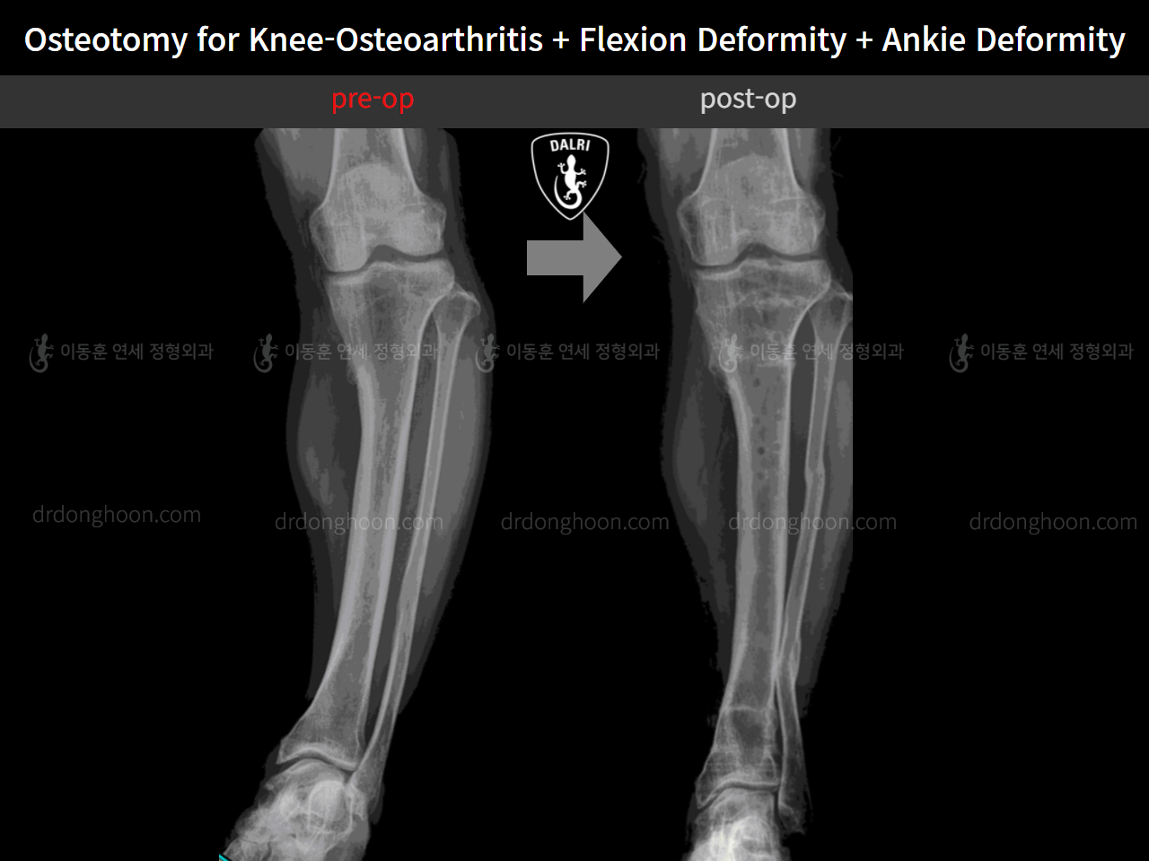 Before and after osteotomy for knee osteoarthritis, case 5315780, image 6, Dr. Donghoon institute (DALRI)